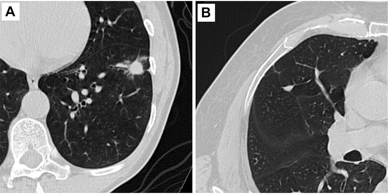 RSNA Radiology 2022, Pulmonary Nodule AI Scores